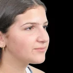 Thumbnail photo of the patient’s before the Rhinoplasty Patient 28