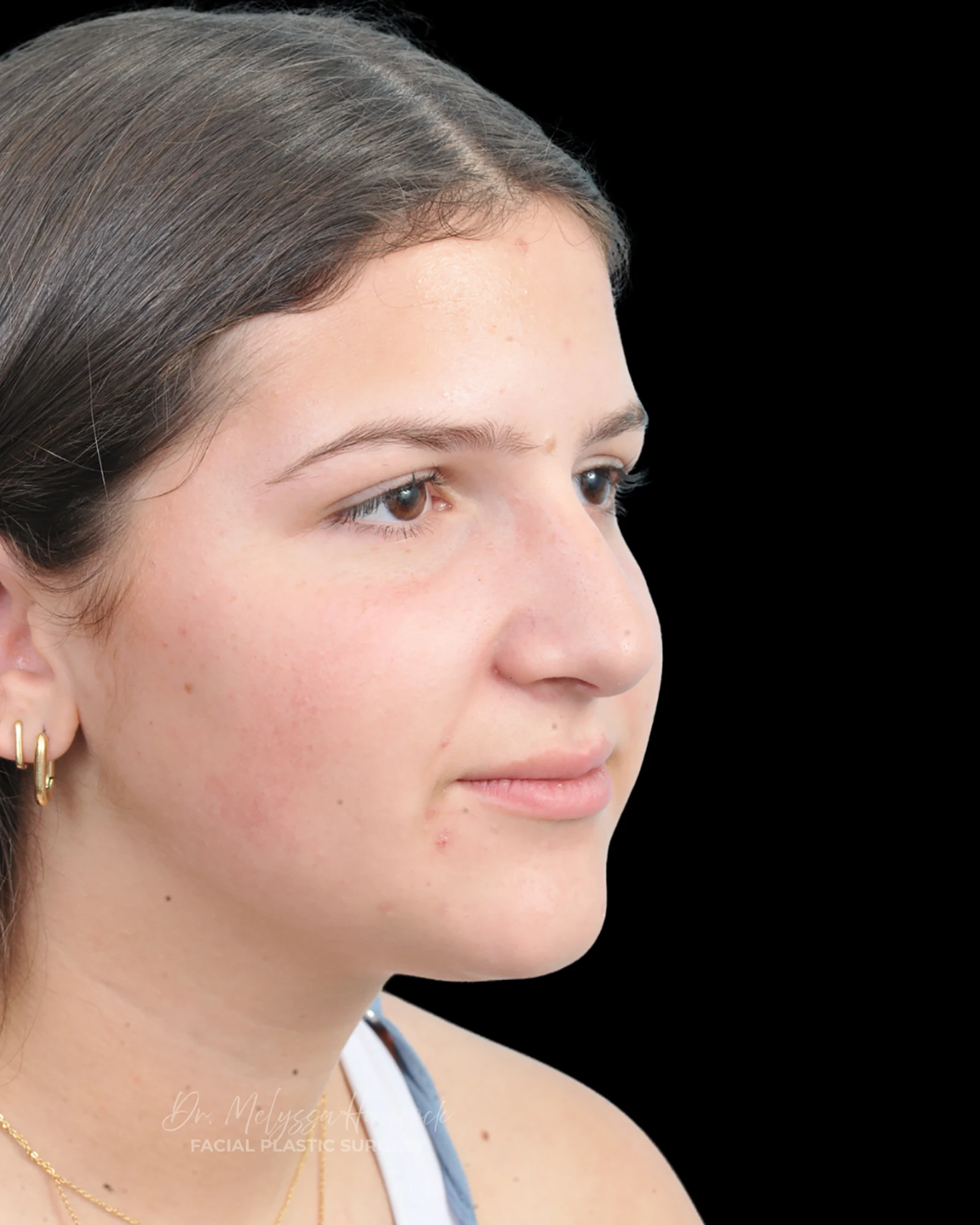 Photo of the patient’s before the Rhinoplasty Patient 28