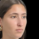 Thumbnail photo of the patient’s before the Rhinoplasty Patient 29