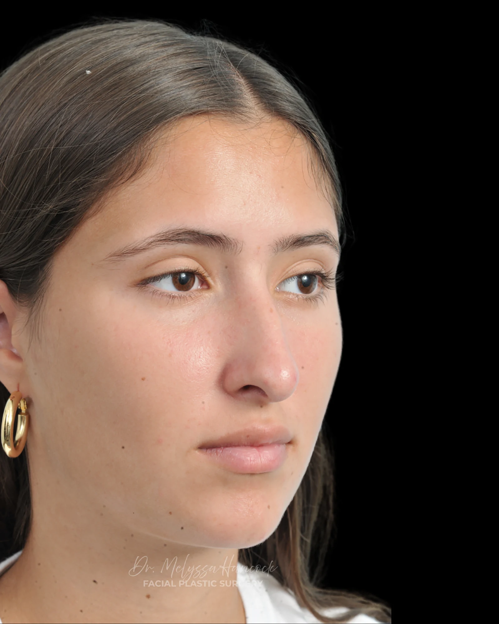 Photo of the patient’s before the Rhinoplasty Patient 29