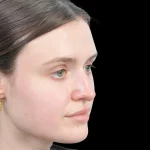 Thumbnail photo of the patient’s before the Rhinoplasty Patient 30