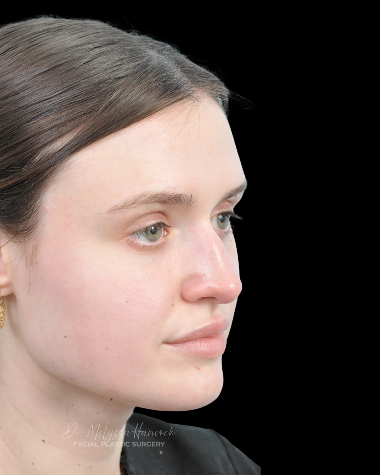 Photo of the patient’s before the Rhinoplasty Patient 30
