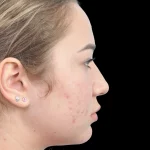 Thumbnail photo of the patient’s before the Rhinoplasty Patient 15