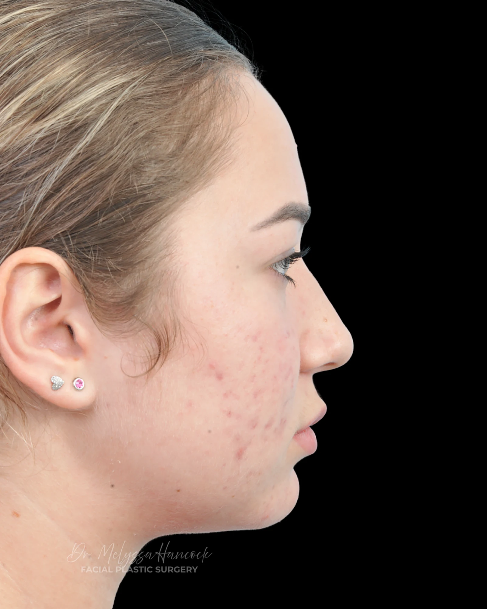 Photo of the patient’s before the Rhinoplasty Patient 15