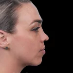 Thumbnail photo of the patient’s before the Rhinoplasty Patient 20