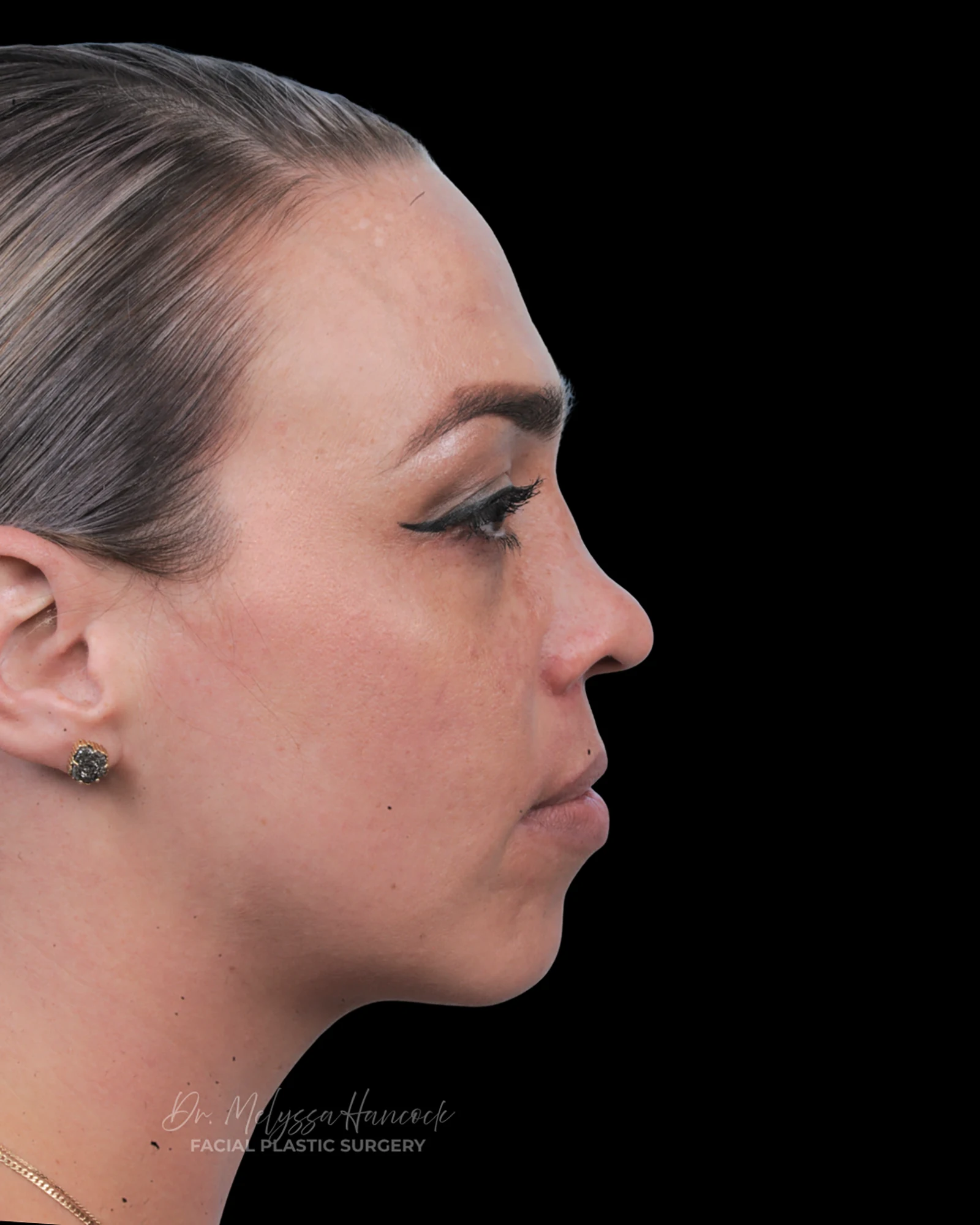 Photo of the patient’s before the Rhinoplasty Patient 20