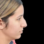 Thumbnail photo of the patient’s before the Rhinoplasty Patient 26
