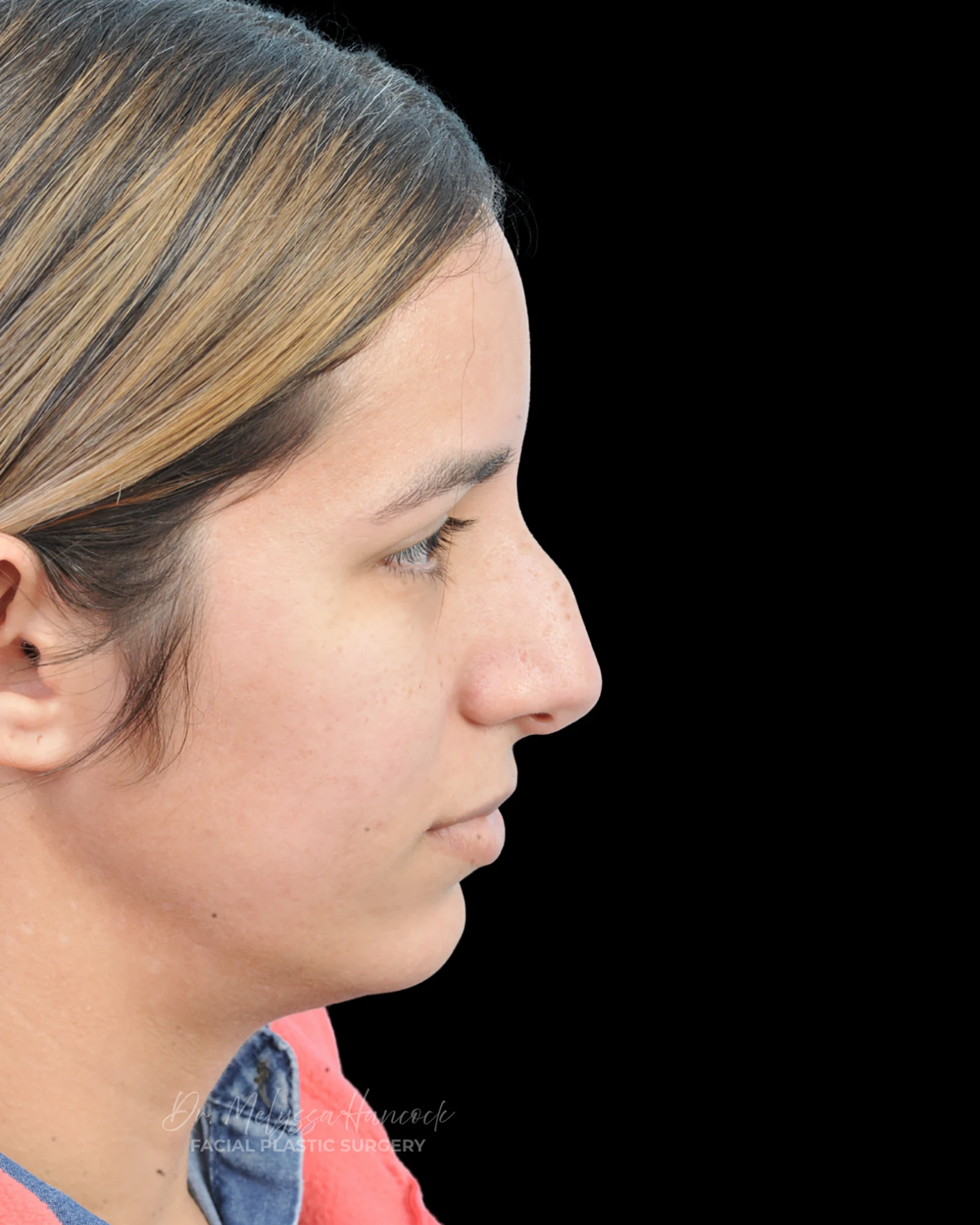 Photo of the patient’s before the Rhinoplasty Patient 26