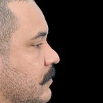 Thumbnail photo of the patient’s before the Rhinoplasty Patient 27