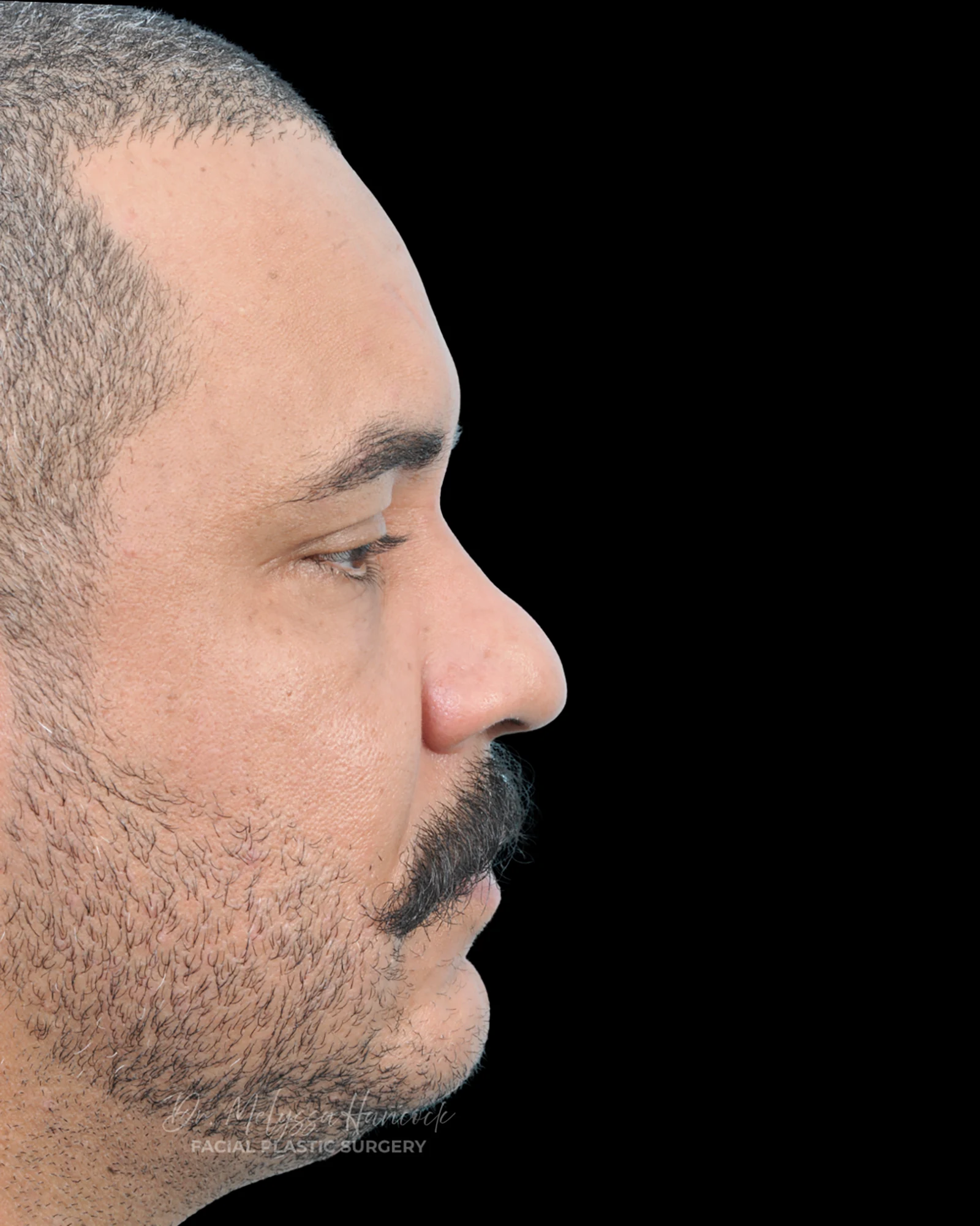 Photo of the patient’s before the Rhinoplasty Patient 27