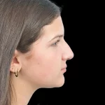 Thumbnail photo of the patient’s before the Rhinoplasty Patient 28