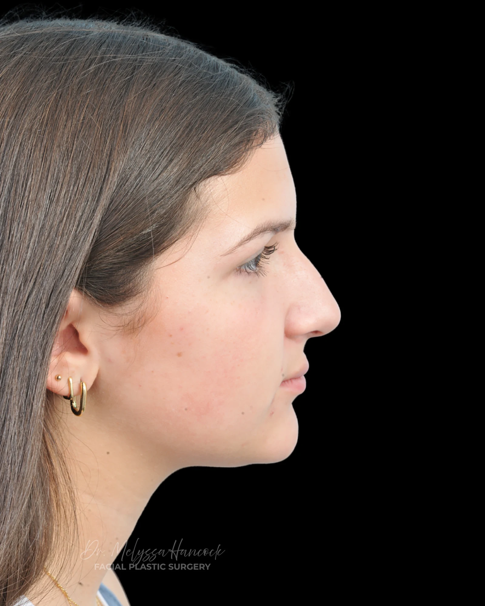 Photo of the patient’s before the Rhinoplasty Patient 28