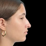 Thumbnail photo of the patient’s before the Rhinoplasty Patient 29