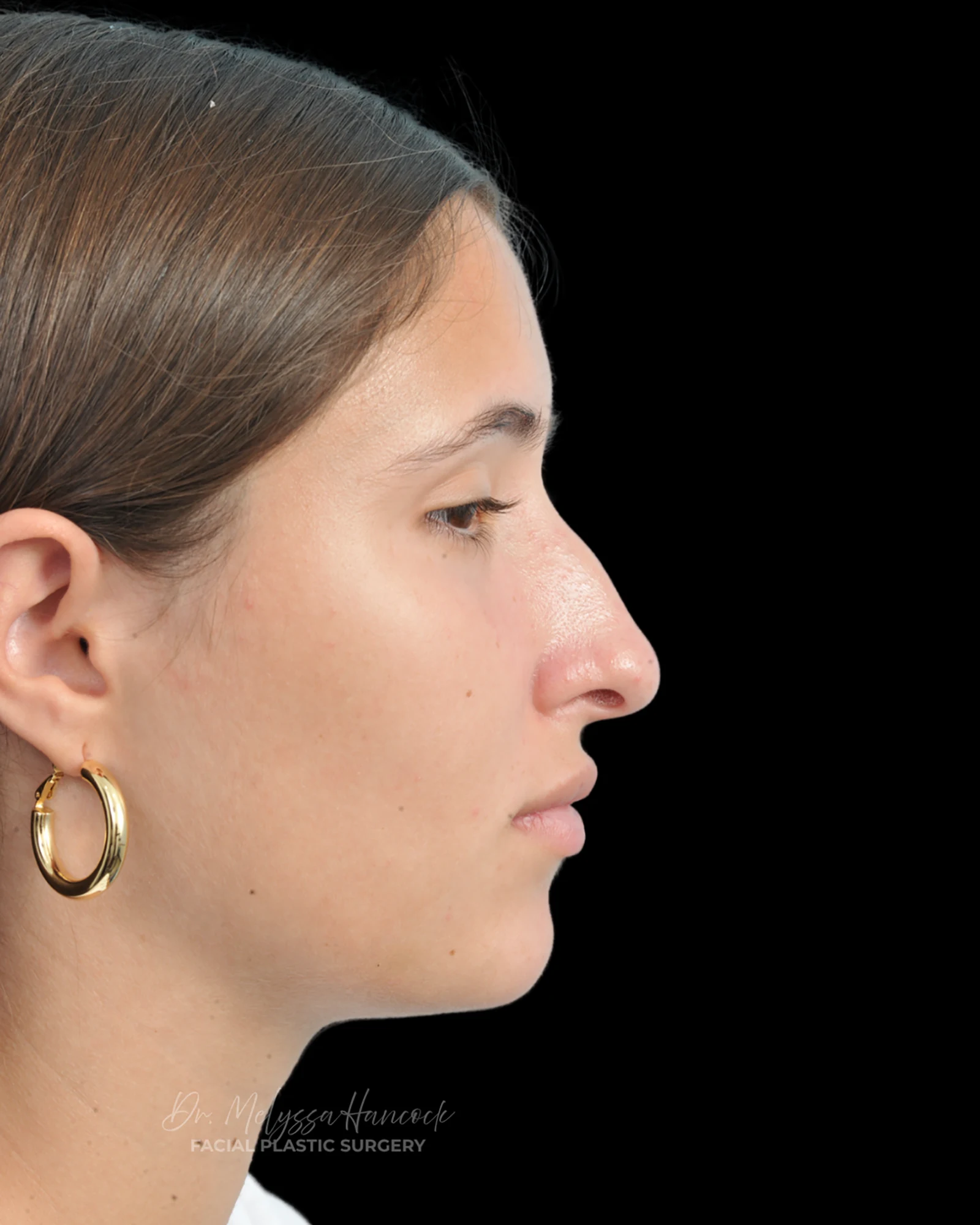 Photo of the patient’s before the Rhinoplasty Patient 29