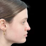 Thumbnail photo of the patient’s before the Rhinoplasty Patient 30