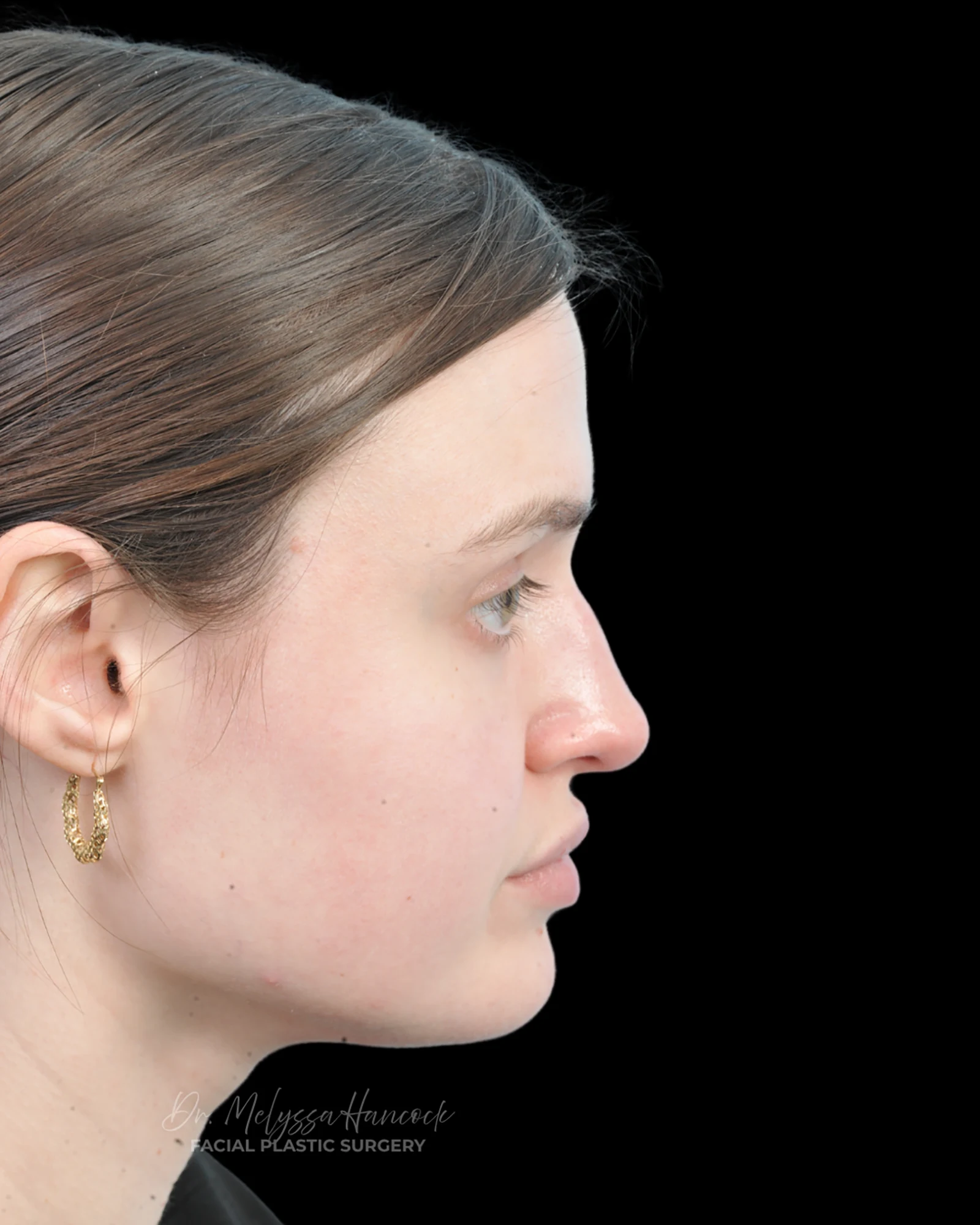 Photo of the patient’s before the Rhinoplasty Patient 30