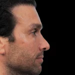 Thumbnail photo of the patient’s before the Rhinoplasty Patient 31