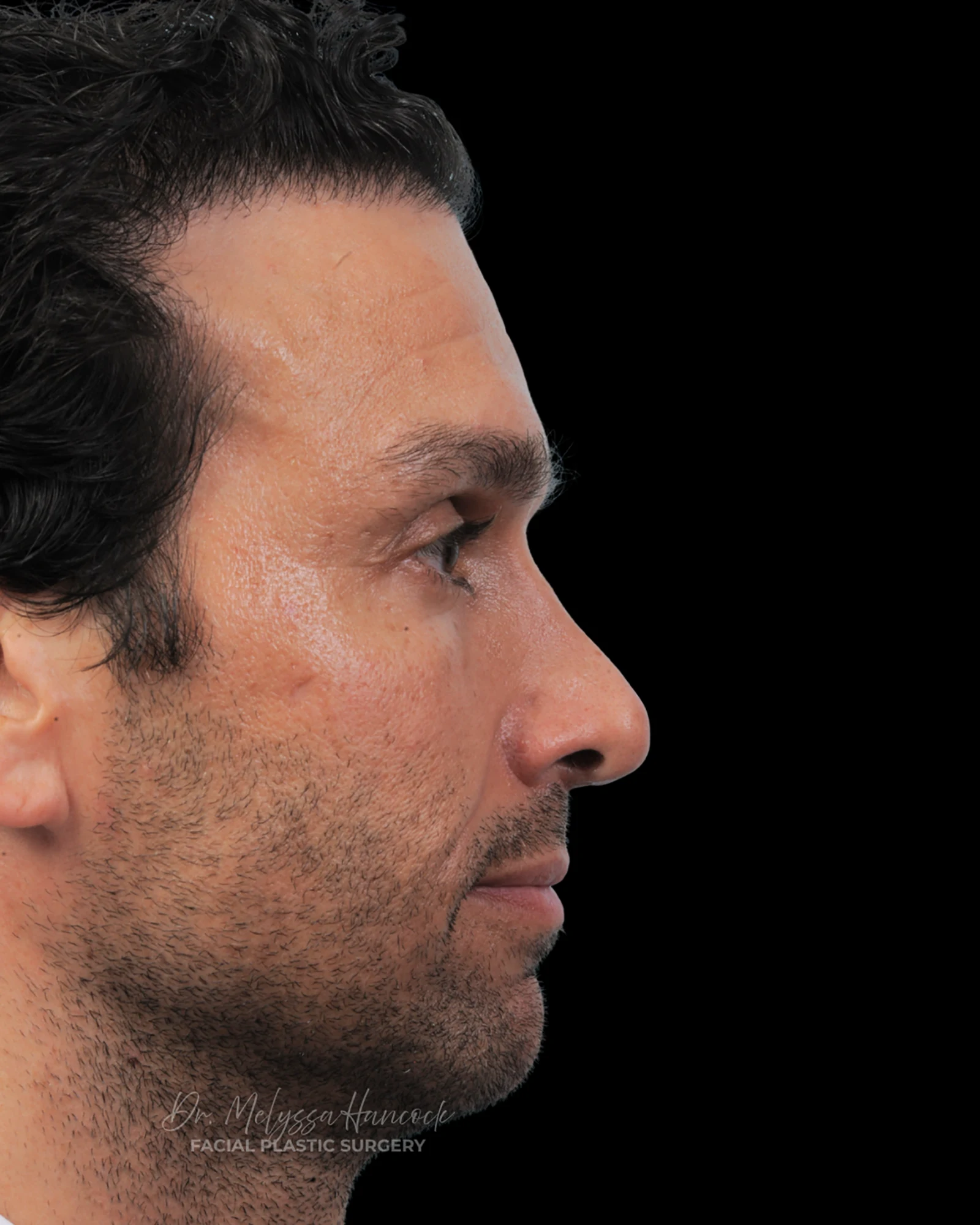 Photo of the patient’s before the Rhinoplasty Patient 31