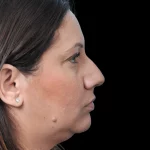 Thumbnail photo of the patient’s before the Rhinoplasty Patient 32