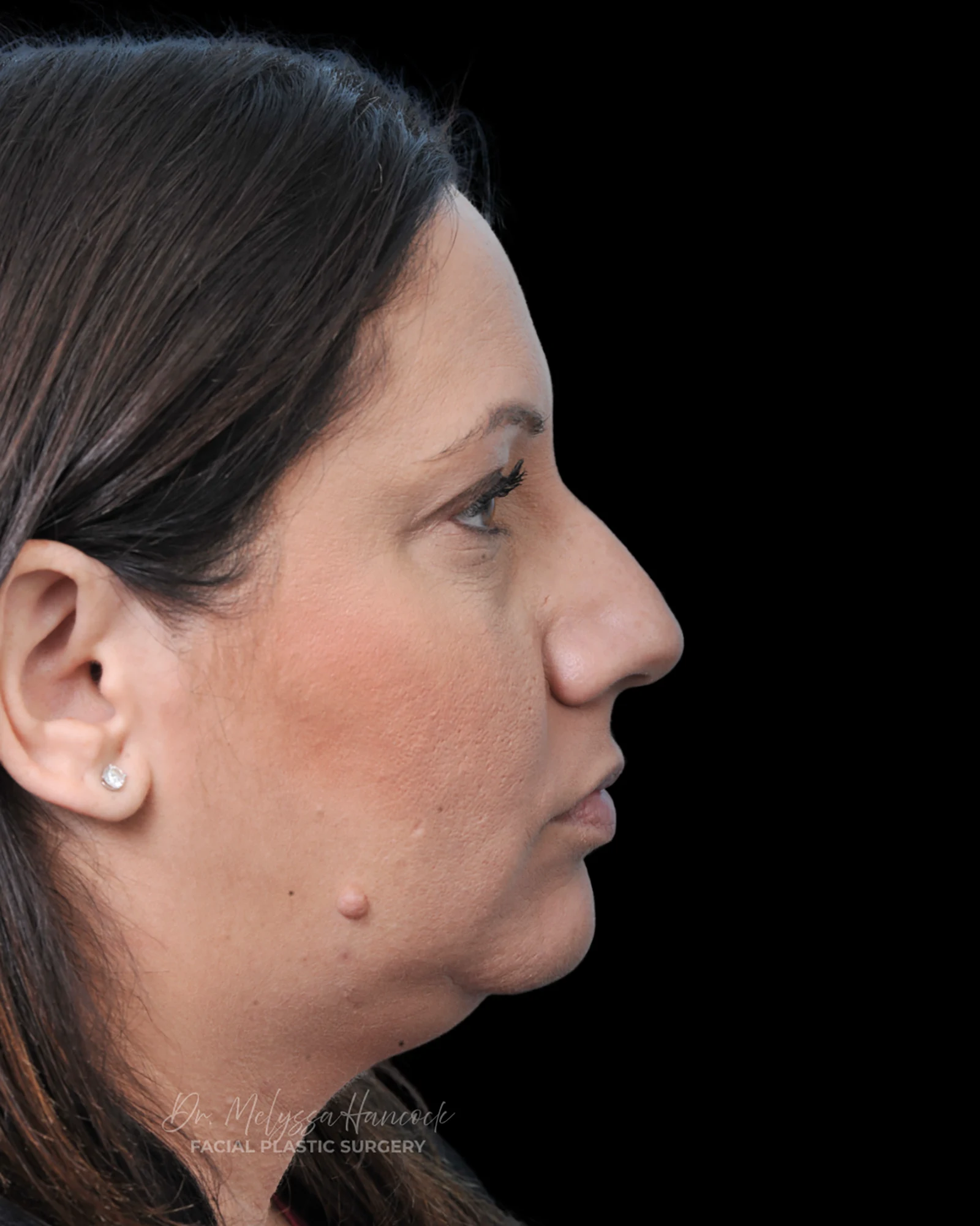 Photo of the patient’s before the Rhinoplasty Patient 32