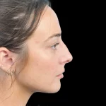 Thumbnail photo of the patient’s before the Rhinoplasty Patient 33