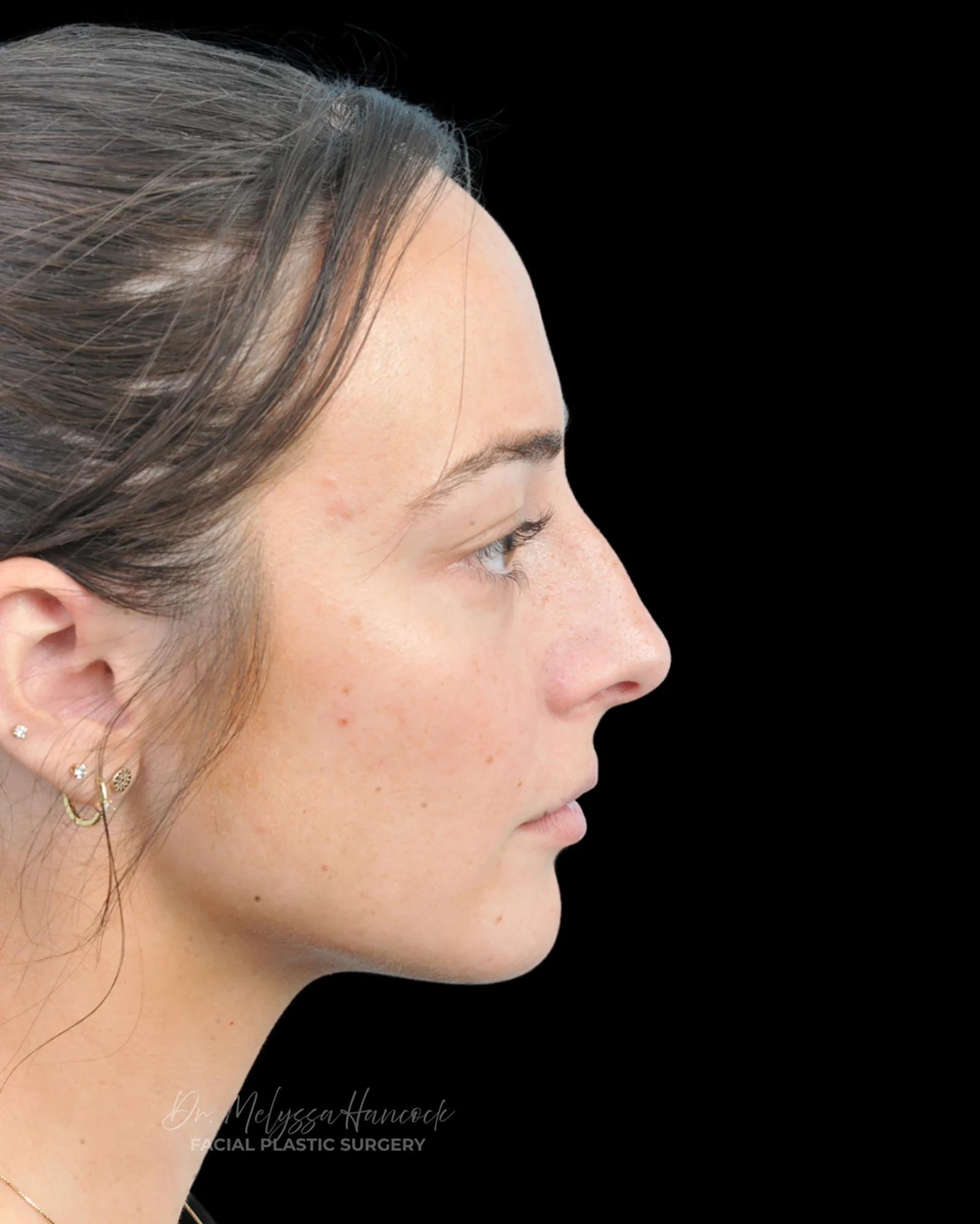 Photo of the patient’s before the Rhinoplasty Patient 33