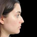 Thumbnail photo of the patient’s before the Rhinoplasty Patient 34