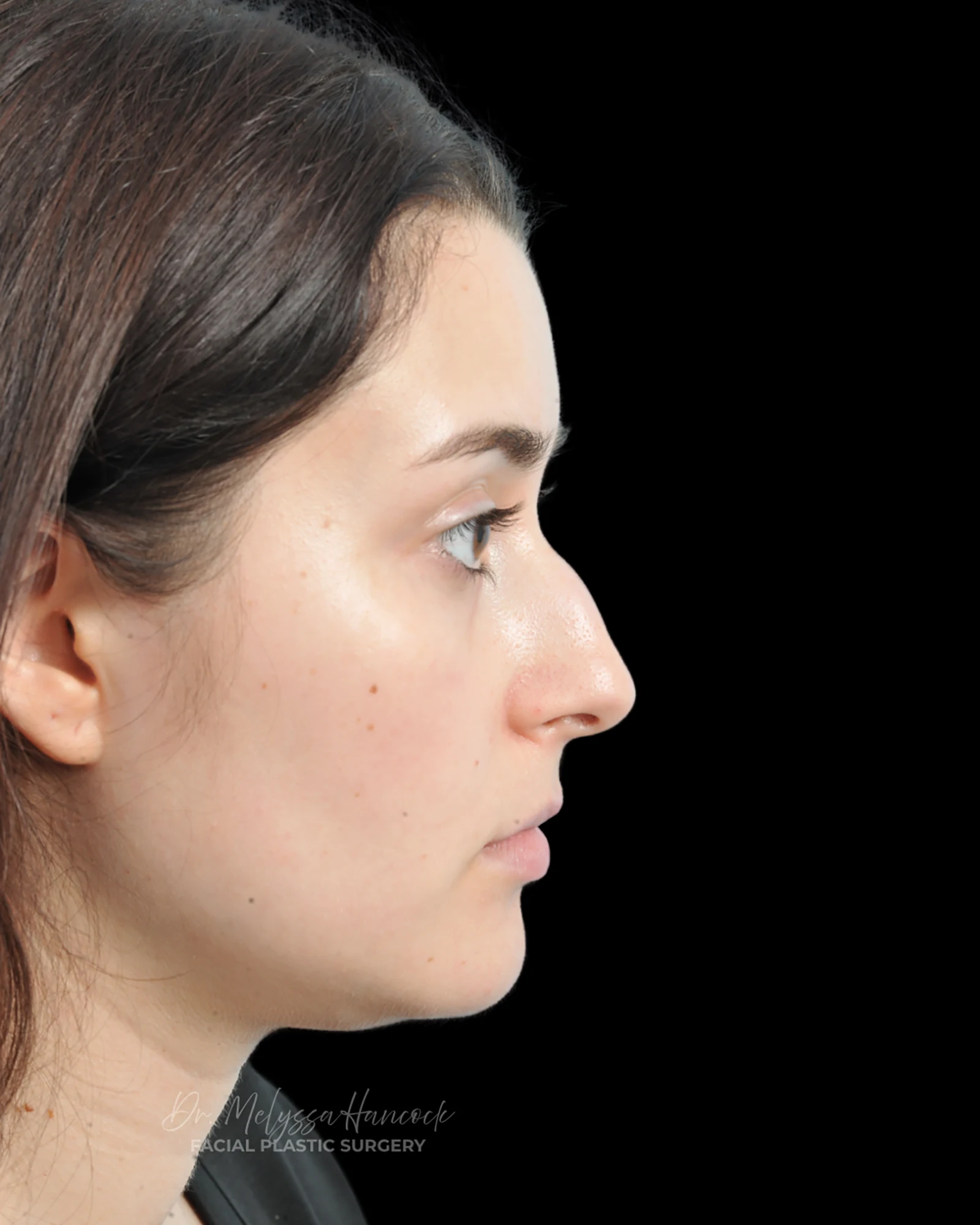 Photo of the patient’s before the Rhinoplasty Patient 34