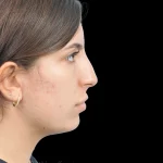 Thumbnail photo of the patient’s before the Rhinoplasty Patient 35