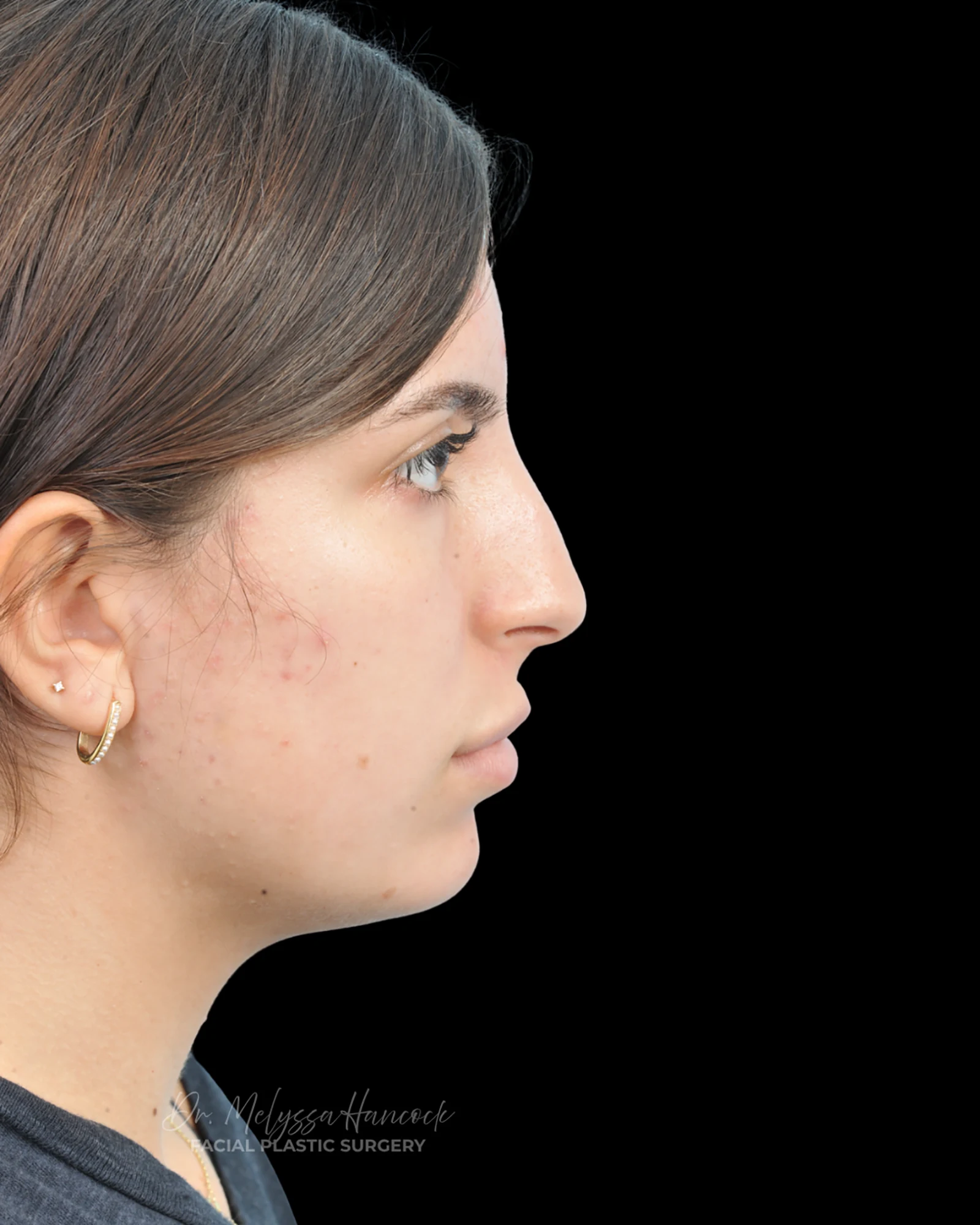 Photo of the patient’s before the Rhinoplasty Patient 35