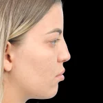 Thumbnail photo of the patient’s before the Rhinoplasty Patient 36