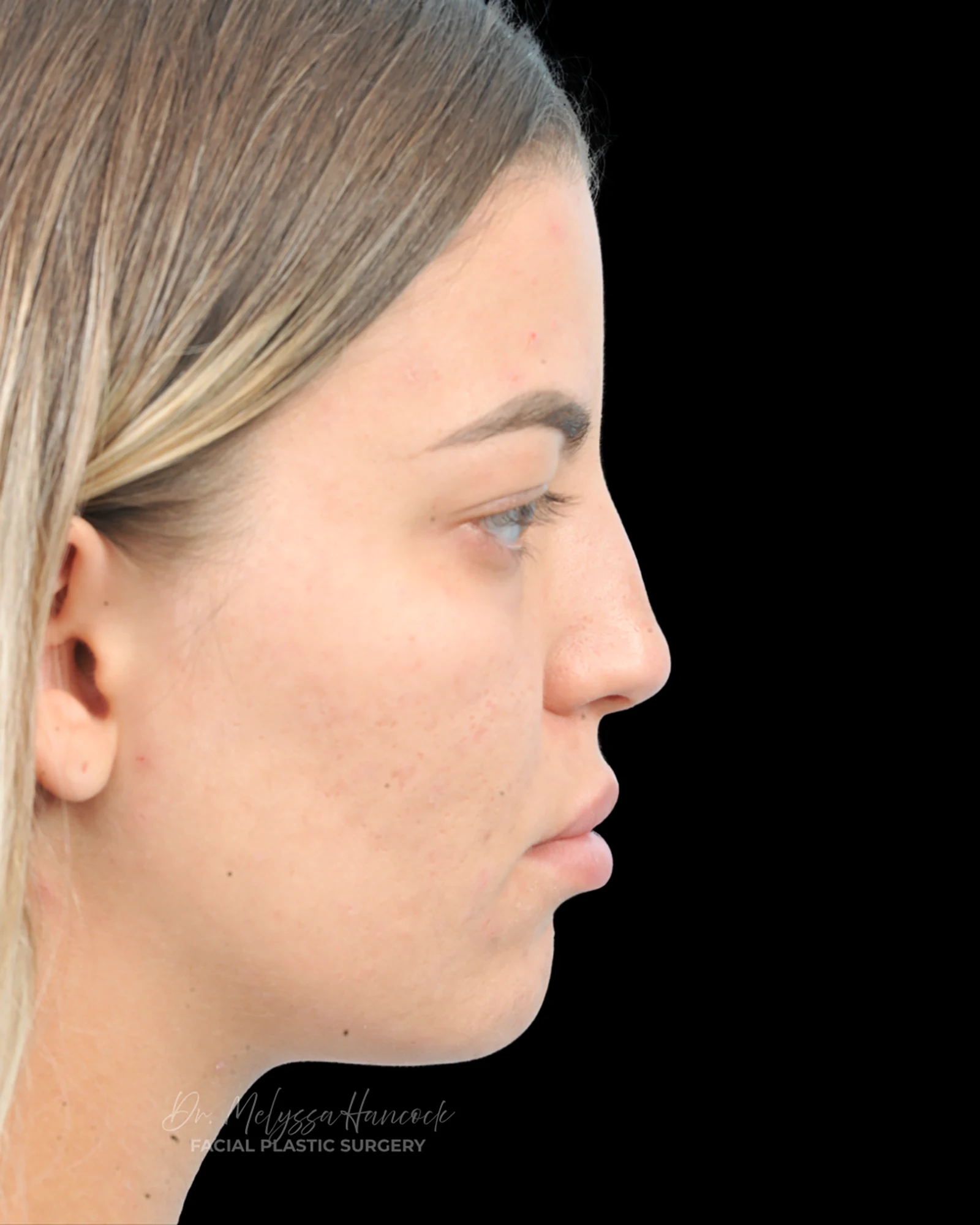 Photo of the patient’s before the Rhinoplasty Patient 36