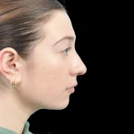 Thumbnail photo of the patient’s before the Rhinoplasty Patient 37