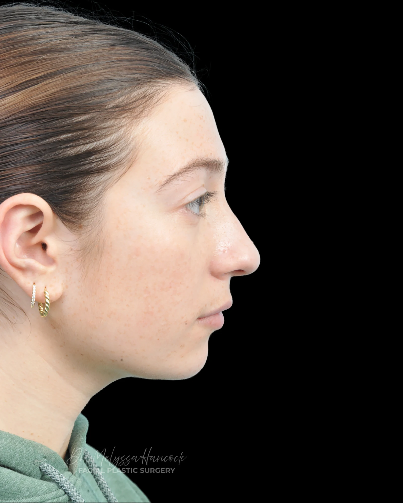 Photo of the patient’s before the Rhinoplasty Patient 37