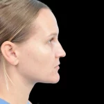 Thumbnail photo of the patient’s before the Rhinoplasty Patient 38