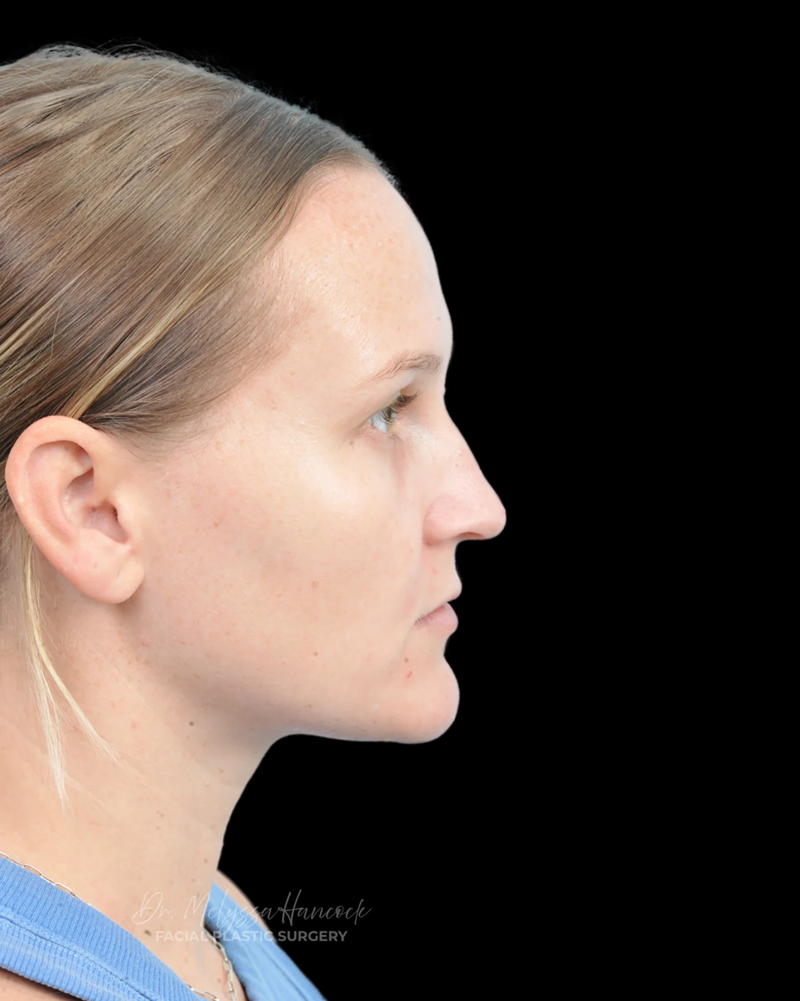 Photo of the patient’s before the Rhinoplasty Patient 38