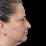 Thumbnail photo of the patient’s before the Rhinoplasty Patient 40