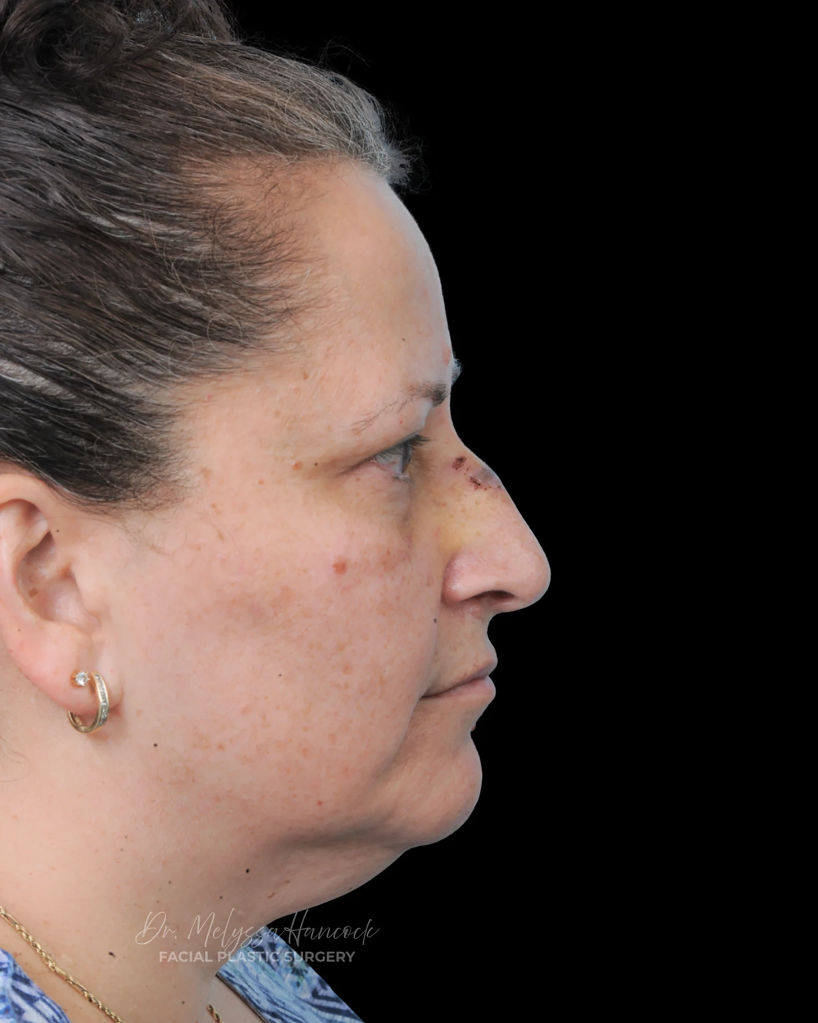 Photo of the patient’s before the Rhinoplasty Patient 40