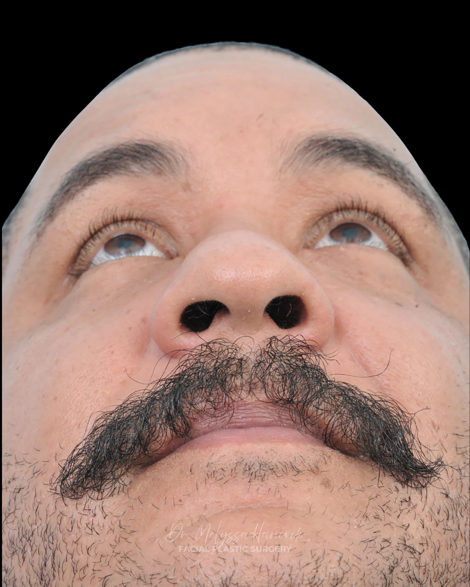 Photo of the patient’s before the Rhinoplasty Patient 27